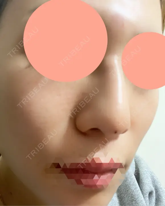 ヒアルロン酸注入（鼻） 博多美容外科/美容皮膚科 ビラビューティークリニック DAY 0 メイン用