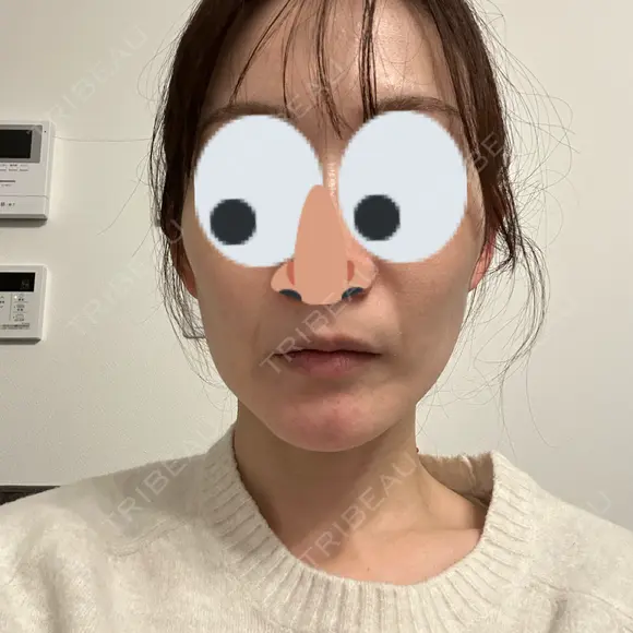 ハイフ（顔） Natural Skin Clinic 自由ヶ丘院 AFTER メイン用