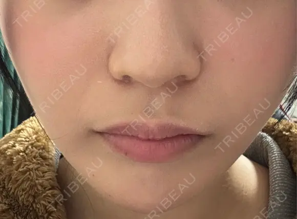 ハイフ（顔） Natural Skin Clinic 自由ヶ丘院 DAY 1 メイン用
