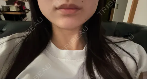 ボトックス（エラ・小顔） 小暮整形外科・美容外科 AFTER メイン用