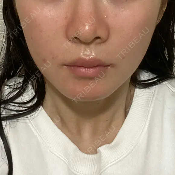 ヒアルロン酸注入（頬） / ヒアルロン酸注入（鼻翼基部） KIMI CLINIC 形成・美容外科 DAY 4 メイン用