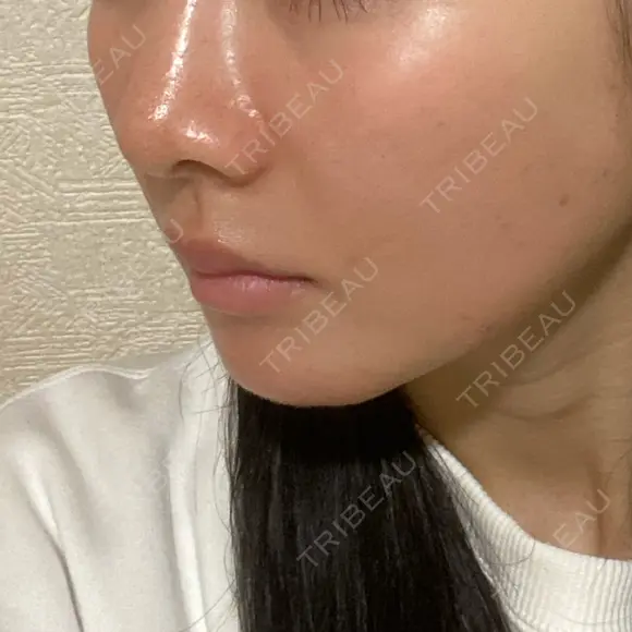 ヒアルロン酸注入（頬） / ヒアルロン酸注入（鼻翼基部） KIMI CLINIC 形成・美容外科 DAY 4 メイン用