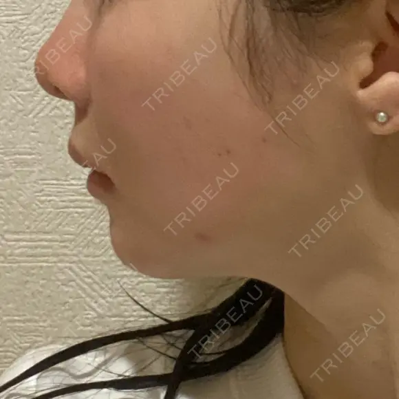 ヒアルロン酸注入（頬） / ヒアルロン酸注入（鼻翼基部） KIMI CLINIC 形成・美容外科 DAY 4 メイン用