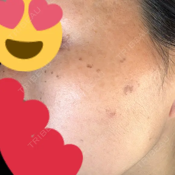 ピコスポット Fellez Clinic【フェルズクリニック】 DAY 6 メイン用