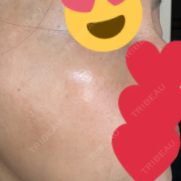 ピコスポット Fellez Clinic【フェルズクリニック】 DAY 8 メイン用