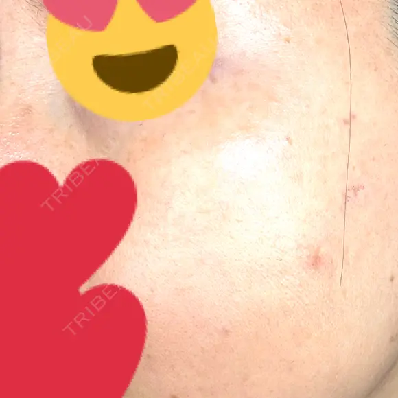 ピコスポット Fellez Clinic【フェルズクリニック】 DAY 8 メイン用