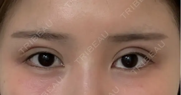 二重埋没 湘南美容クリニック 千葉センシティ院 DAY 0 メイン用