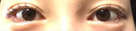 目尻切開 / タレ目形成・グラマラスライン（埋没） LOUIS CLINIC 二子玉川院【ルイクリニック】 DAY 2 メイン用