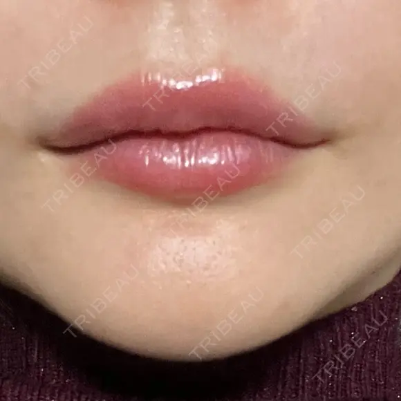 ヒアルロン酸注入（唇） / ヒアルロン酸注入（鼻翼基部） Moon Beauty Clinic AFTER メイン用