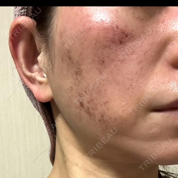 光治療（フォトフェイシャルなど） / RF（高周波）たるみ治療 / ルメッカ / インモード BITO BEAUTY CLINIC DAY 2 メイン用