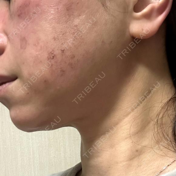 光治療（フォトフェイシャルなど） / RF（高周波）たるみ治療 / ルメッカ / インモード BITO BEAUTY CLINIC DAY 2 メイン用