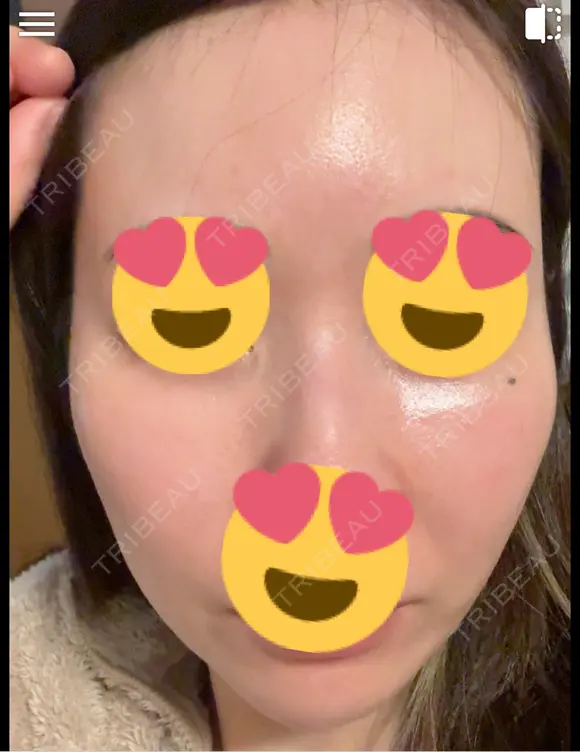 毛穴洗浄（ハイドラフェイシャルなど） / ピコレーザートーニング（美白・肝斑） 表参道ウィズ・クリニック AFTER メイン用