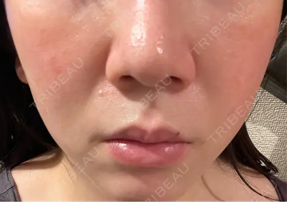 ハイフ（顔） Natural Skin Clinic 自由ヶ丘院 DAY 0 メイン用