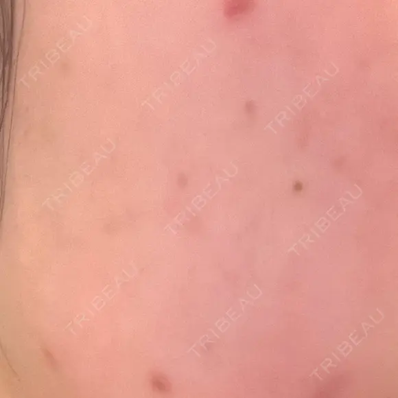 ほくろ・いぼ除去レーザー（肌） 心斎橋KT美容クリニック DAY 5 メイン用