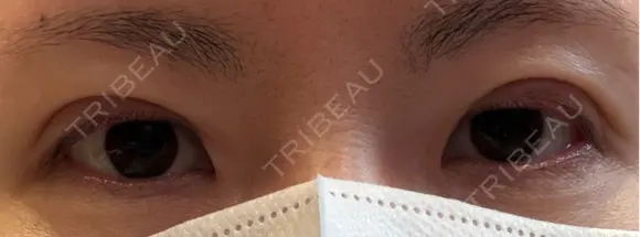 二重埋没 湘南美容クリニック 千葉センシティ院 DAY 1 メイン用