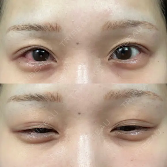 ヒアルロン酸注入（涙袋） 小倉美容外科/美容皮膚科 ビラビューティークリニック DAY 4 メイン用