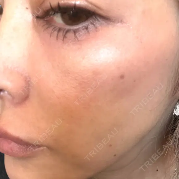 ピコレーザートーニング（美白・肝斑） / ピコフラクショナルレーザー（毛穴・ニキビ跡） しんゆり美容健康クリニック AFTER メイン用