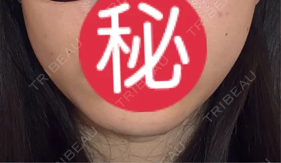 オンダリフト LIGHT CLINIC 【ライトクリニック】 名古屋院 DAY 7 メイン用