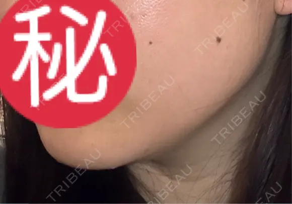 オンダリフト LIGHT CLINIC 【ライトクリニック】 名古屋院 DAY 7 メイン用