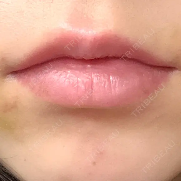 ヒアルロン酸注入（唇） HAAB×DREAM BEAUTY CLINIC 大阪梅田院 AFTER メイン用