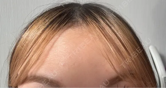 ボトックス（眉間） / ボトックス（額） ルラ美容クリニック 渋谷本院 AFTER メイン用