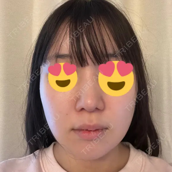 デンシティ DAILY SKIN CLINIC 新宿院 DAY 0 メイン用