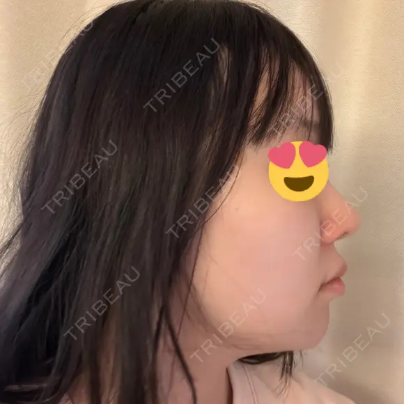 デンシティ DAILY SKIN CLINIC 新宿院 DAY 0 メイン用