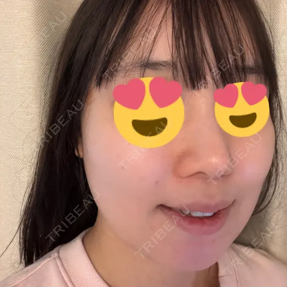 デンシティ DAILY SKIN CLINIC 新宿院 DAY 0 メイン用