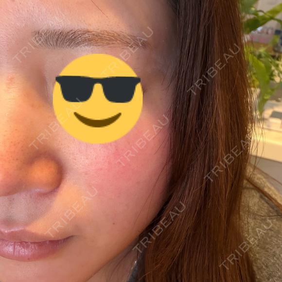 ルメッカ BITO BEAUTY CLINIC DAY 0 メイン用