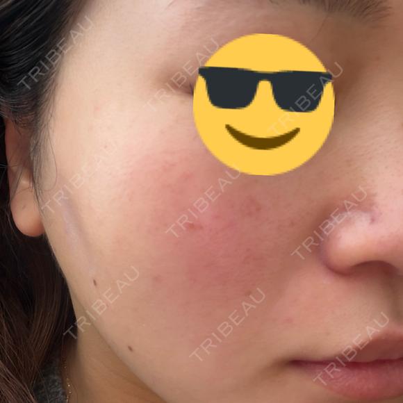 ルメッカ BITO BEAUTY CLINIC DAY 0 メイン用