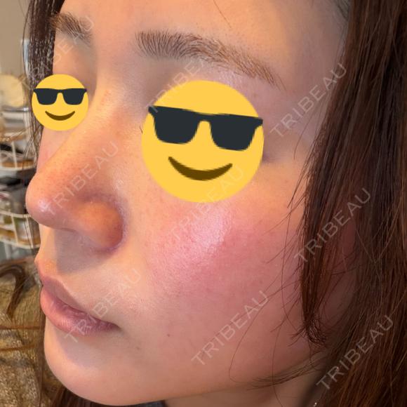 ルメッカ BITO BEAUTY CLINIC DAY 0 メイン用