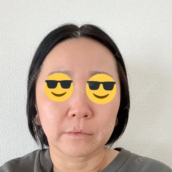 脂肪溶解注射（顔） ルラ美容クリニック 仙台院 / ルラスキンクリニック 仙台院 DAY 5 メイン用