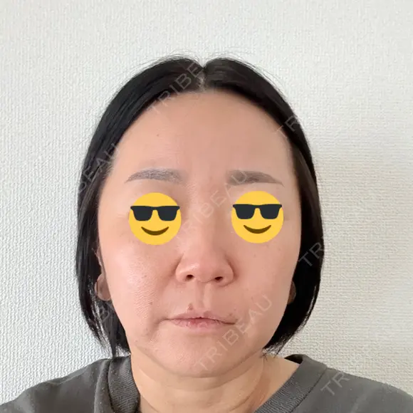 脂肪溶解注射（顔） ルラ美容クリニック 仙台院 / ルラスキンクリニック 仙台院 AFTER メイン用