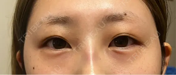 ヒアルロン酸注入（涙袋） ルラ美容クリニック 宇都宮院 DAY 0 メイン用