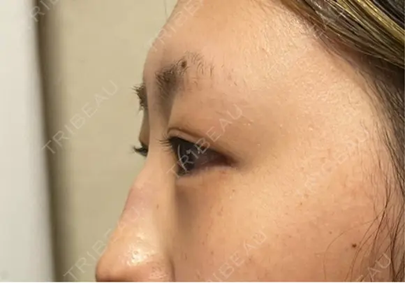 ヒアルロン酸注入（涙袋） ルラ美容クリニック 宇都宮院 DAY 0 メイン用