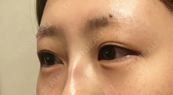 ヒアルロン酸注入（涙袋） ルラ美容クリニック 宇都宮院 DAY 0 メイン用