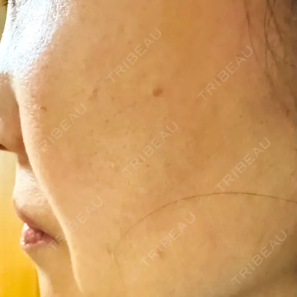 エレクトロポレーション / ルメッカ ON-CLINIC Beauty AFTER メイン用