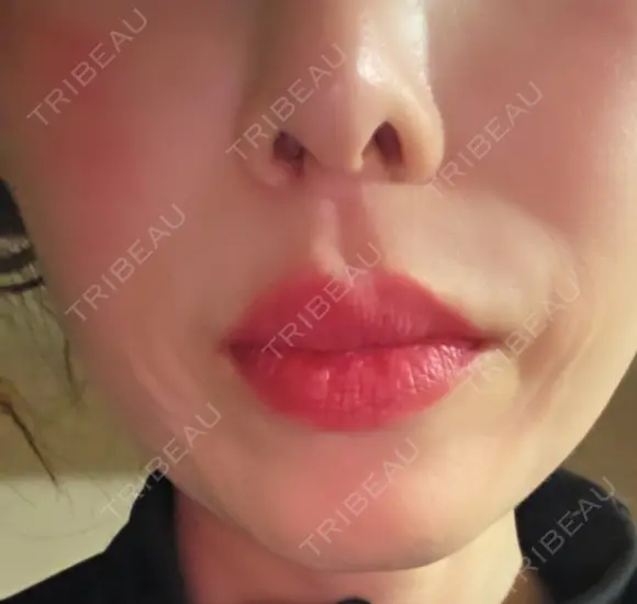 肌ヒアルロン酸注入（たるみ・シワ改善） HAAB×DREAM BEAUTY CLINIC 大阪梅田院 DAY 1 メイン用