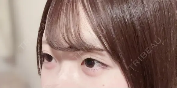 ヒアルロン酸注入（涙袋） / ヒアルロン酸注入（唇） / ボトックス（口角） フィラークリニック 大阪心斎橋院 AFTER メイン用