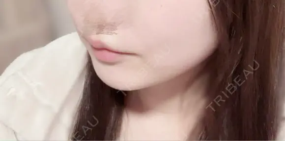 ヒアルロン酸注入（涙袋） / ヒアルロン酸注入（唇） / ボトックス（口角） フィラークリニック 大阪心斎橋院 DAY 1 メイン用