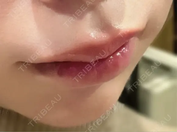 口唇縮小術 Stand by Beauty Clinic DAY 10 メイン用