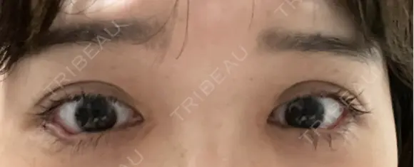 目尻切開 / タレ目形成・グラマラスライン（埋没） LOUIS CLINIC 二子玉川院【ルイクリニック】 DAY 5 メイン用