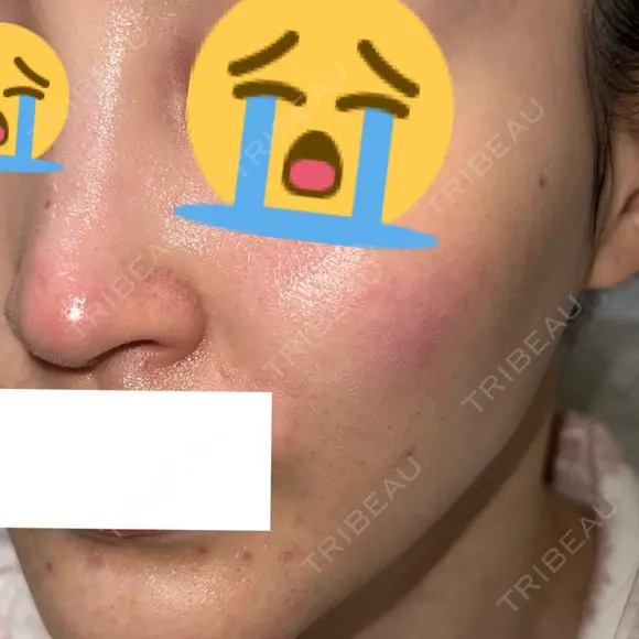 ピコスポット G MEDICAL ART クリニック 新宿院 DAY 1 メイン用