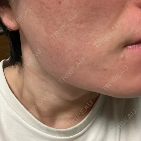 サブシジョン アモーレクリニック 大阪院 AFTER メイン用