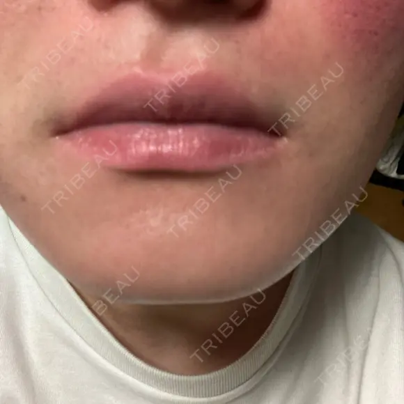 サブシジョン アモーレクリニック 大阪院 DAY 0 メイン用