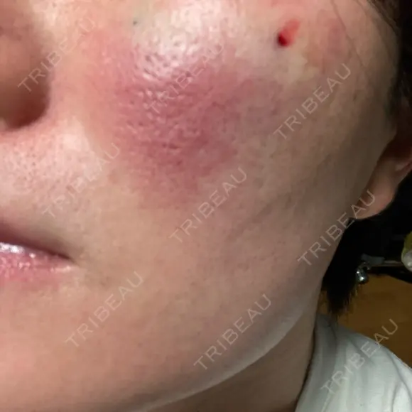 サブシジョン アモーレクリニック 大阪院 DAY 0 メイン用