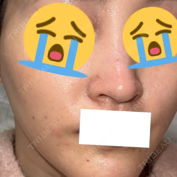 ピコスポット G MEDICAL ART クリニック 新宿院 DAY 3 メイン用