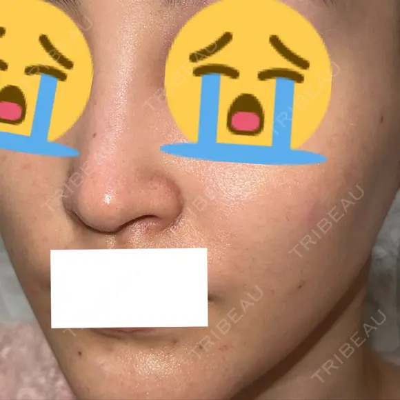 ピコスポット G MEDICAL ART クリニック 新宿院 DAY 3 メイン用