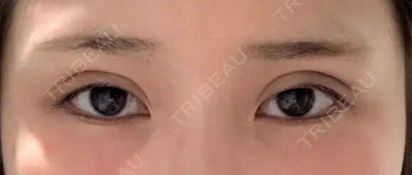 二重埋没 湘南美容クリニック 千葉センシティ院 DAY 1 メイン用