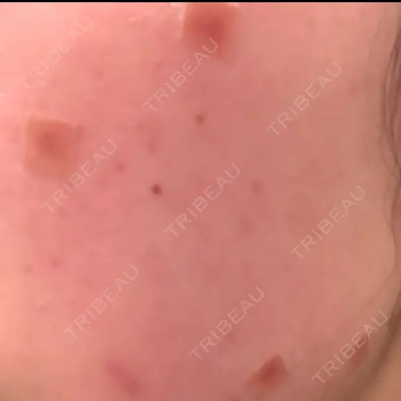 ほくろ・いぼ除去レーザー（肌） 心斎橋KT美容クリニック DAY 6 メイン用